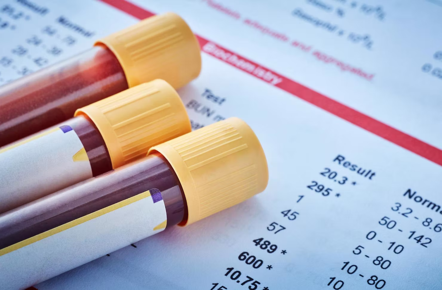 wysoki cholesterol wyniki badań krwi - probówki na lipidogramie z wartościami poza normą